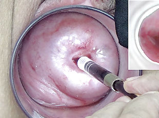 A endoscope japanese camera is inserted in the cervix to watch inside the uterus.